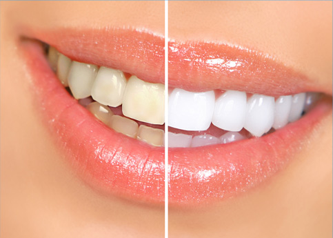 Issaquah teeth whitening